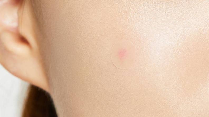 A pimple patch on a person's cheek.